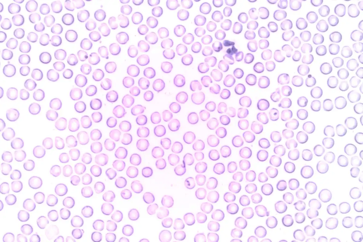 Frotiu de sânge văzut la microscop, cu multe globule roșii și o celulă albă colorată